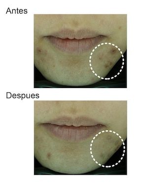 Tratamiento facial Three Herb emulsión dermatológica antiacné Tony Moly