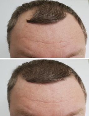 Shampoo anticaída para cabello Minoxidil y Biotina Allskin