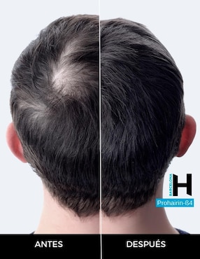 Set tratamiento capilar de loción anticaída con prohairin β4 Barcelona Pharma