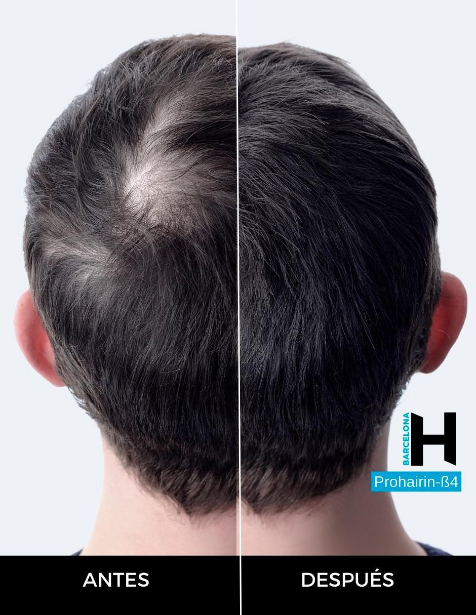 Set tratamiento capilar de loción anticaída con prohairin β4 2